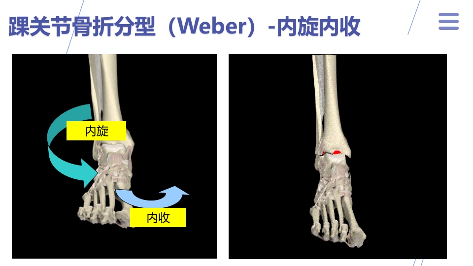 1例左三踝骨折患者的护理查房PPT课件10