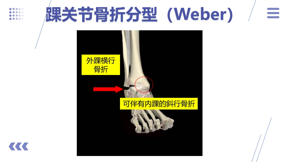 1例左三踝骨折患者的护理查房PPT课件11
