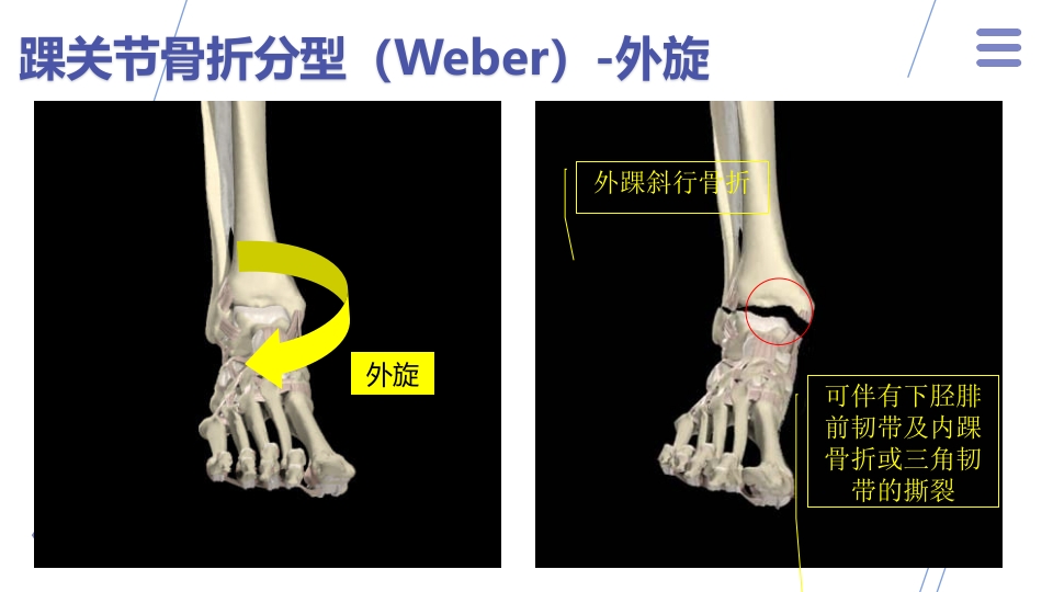 1例左三踝骨折患者的护理查房PPT课件12