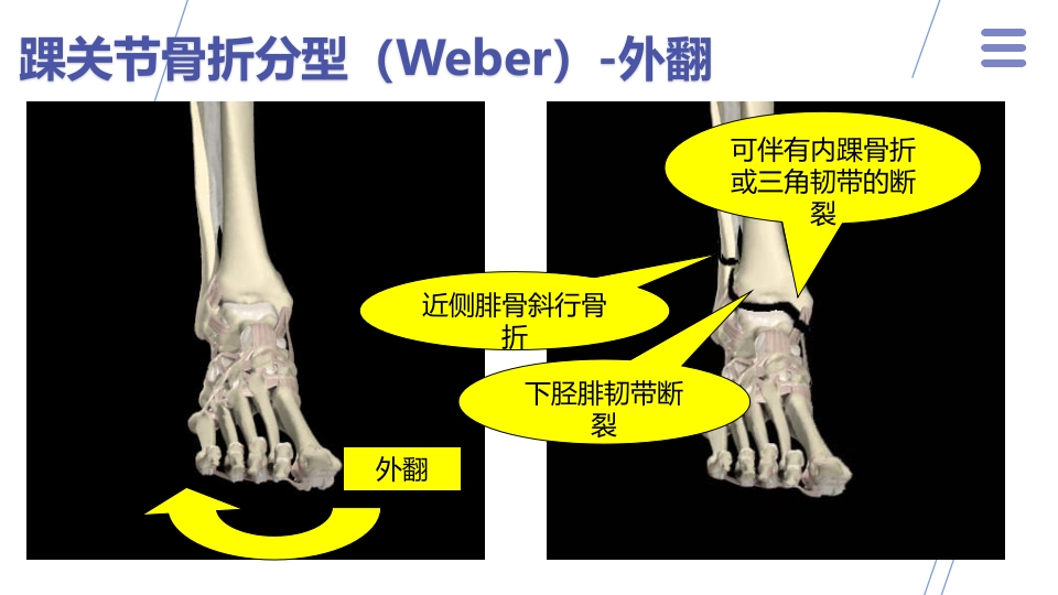 1例左三踝骨折患者的护理查房PPT课件13