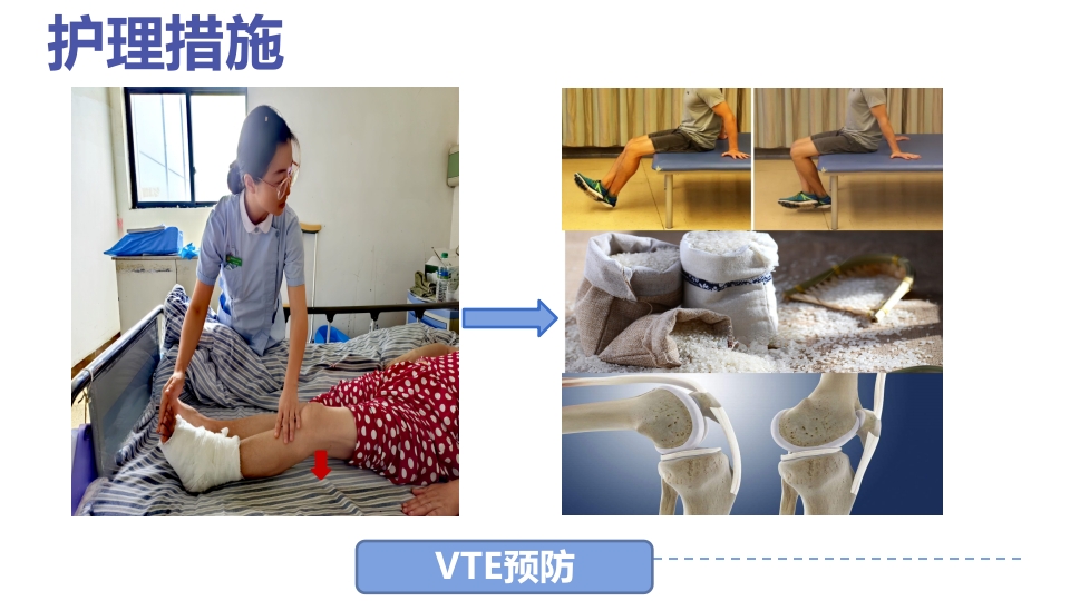 1例左三踝骨折患者的护理查房PPT课件31