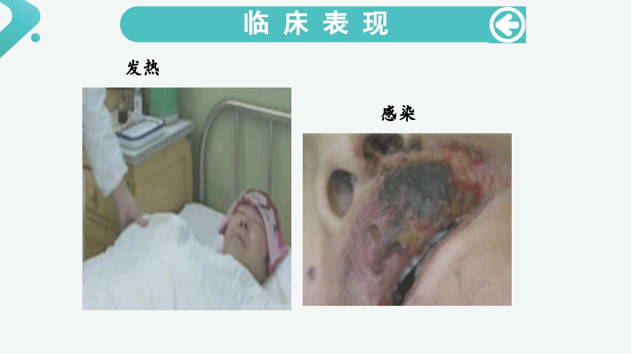 白血病病人的护理PPT课件13