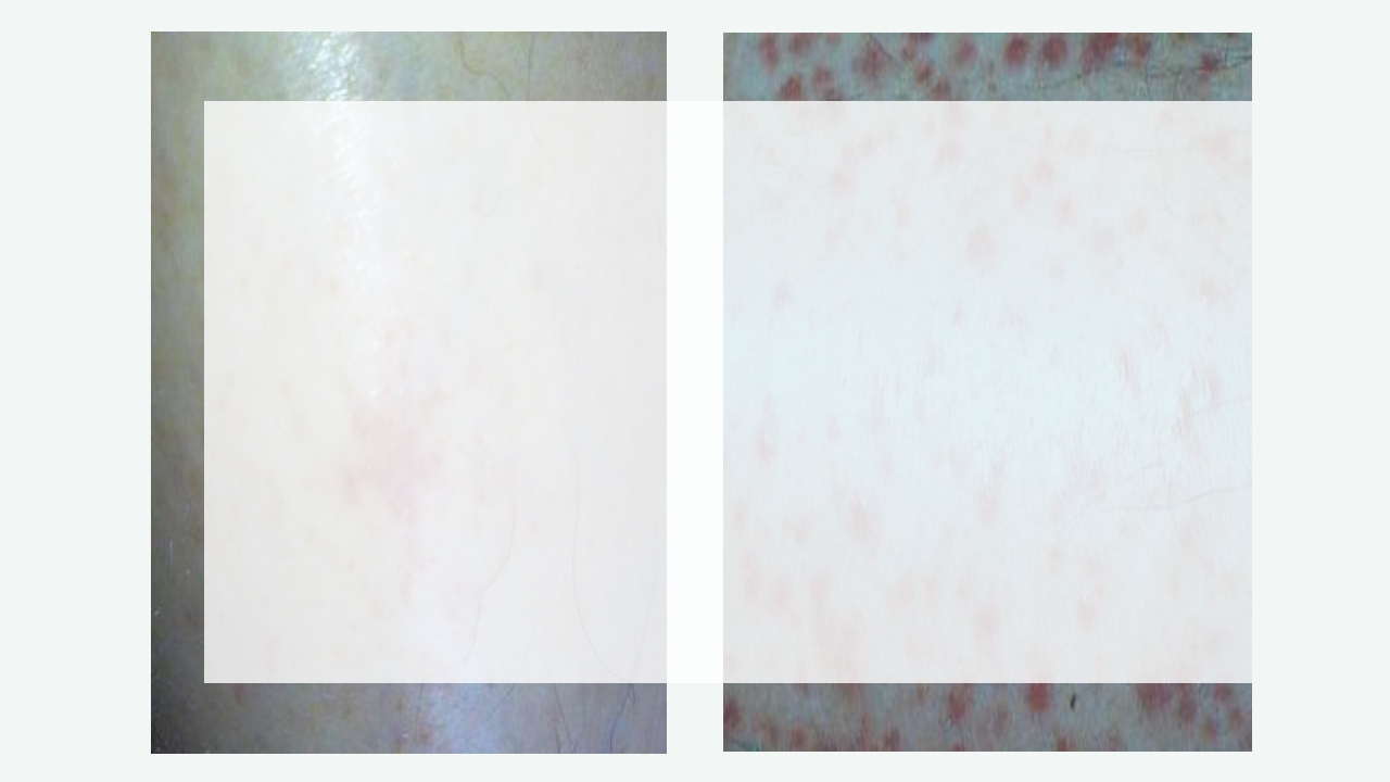 白血病病人的护理PPT课件16