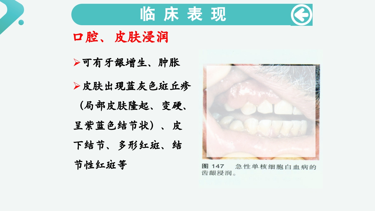 白血病病人的护理PPT课件20