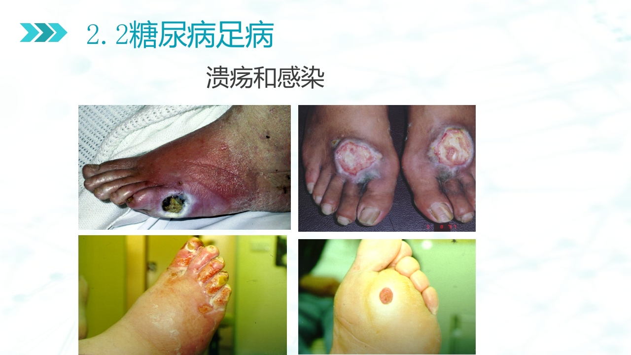 糖尿病足病的健康教育与病人管理PPT课件10