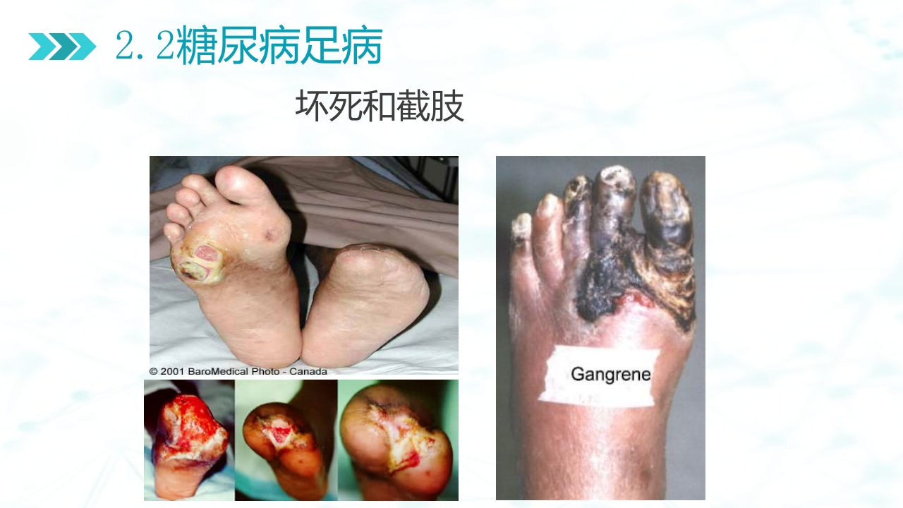 糖尿病足病的健康教育与病人管理PPT课件11