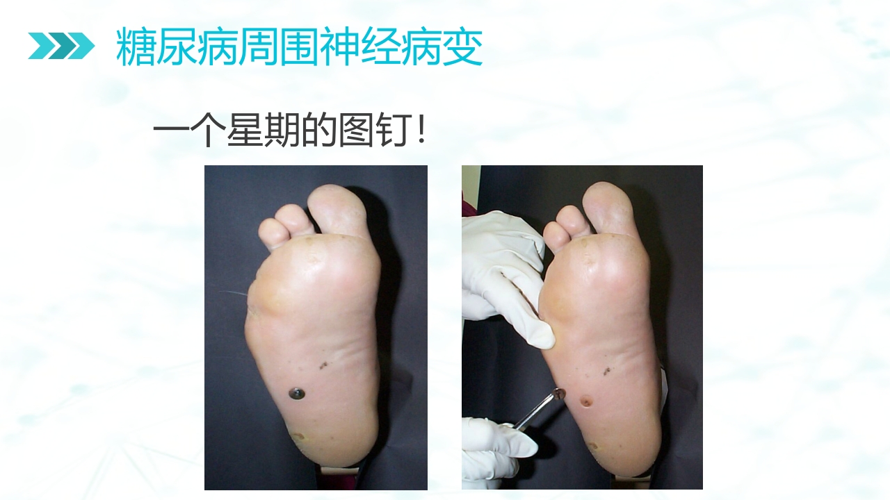 糖尿病足病的健康教育与病人管理PPT课件16