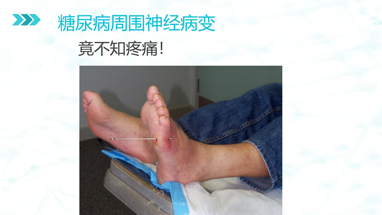 糖尿病足病的健康教育与病人管理PPT课件17