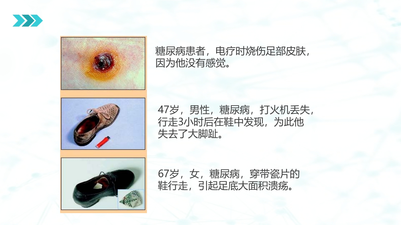 糖尿病足病的健康教育与病人管理PPT课件18