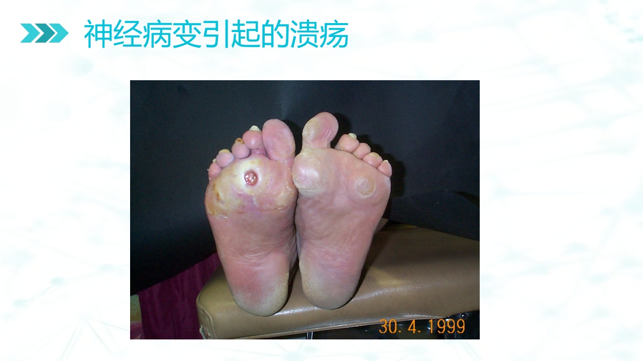 糖尿病足病的健康教育与病人管理PPT课件19