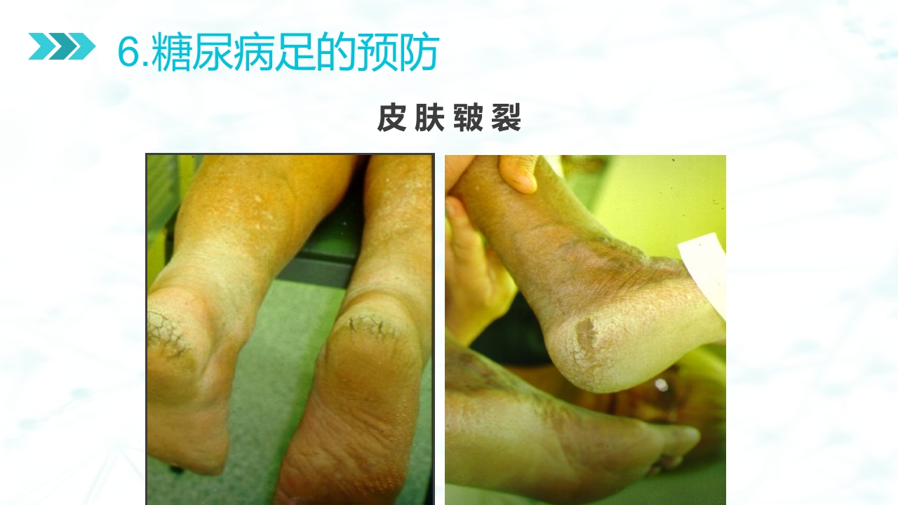 糖尿病足病的健康教育与病人管理PPT课件31