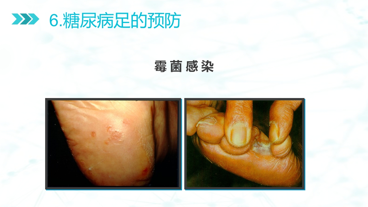 糖尿病足病的健康教育与病人管理PPT课件32