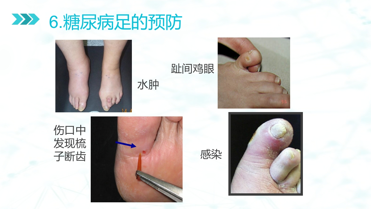 糖尿病足病的健康教育与病人管理PPT课件34