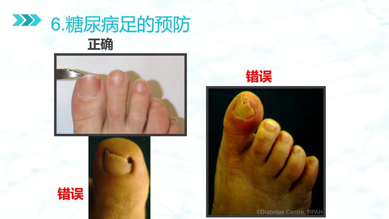 糖尿病足病的健康教育与病人管理PPT课件39