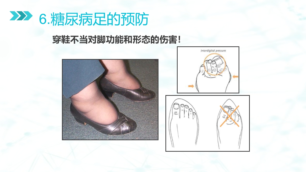 糖尿病足病的健康教育与病人管理PPT课件44