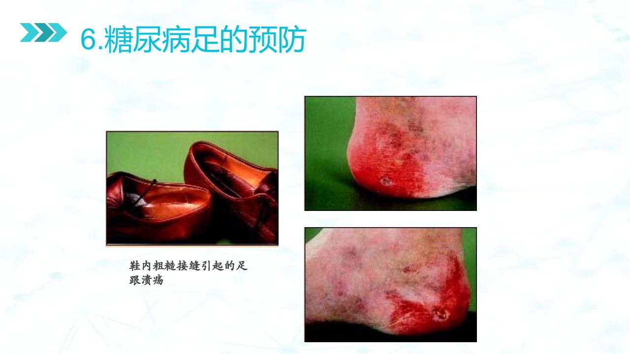 糖尿病足病的健康教育与病人管理PPT课件45