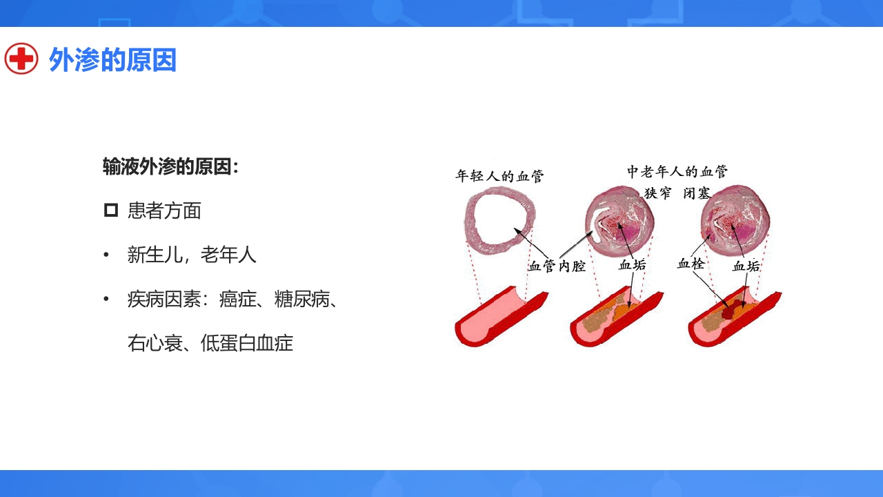 静脉输液外渗的预防与处理PPT课件6