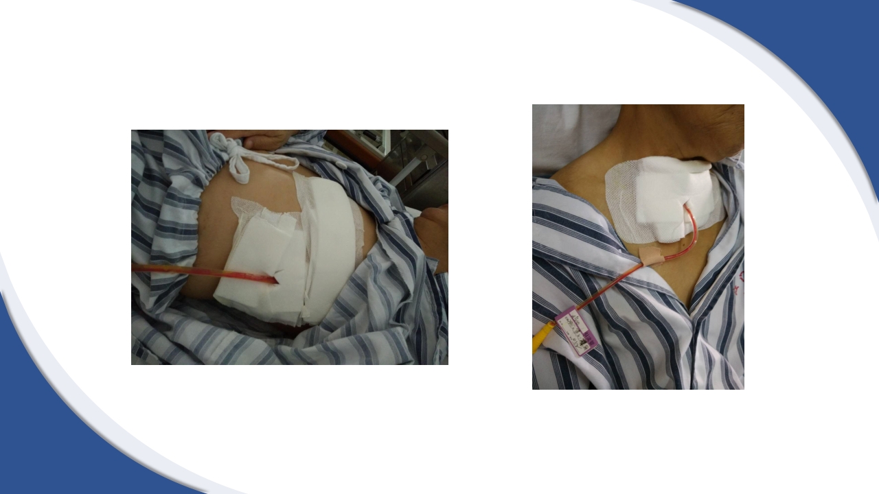 普通外科围手术期护理及术后各类引流管的护理PPT课件51