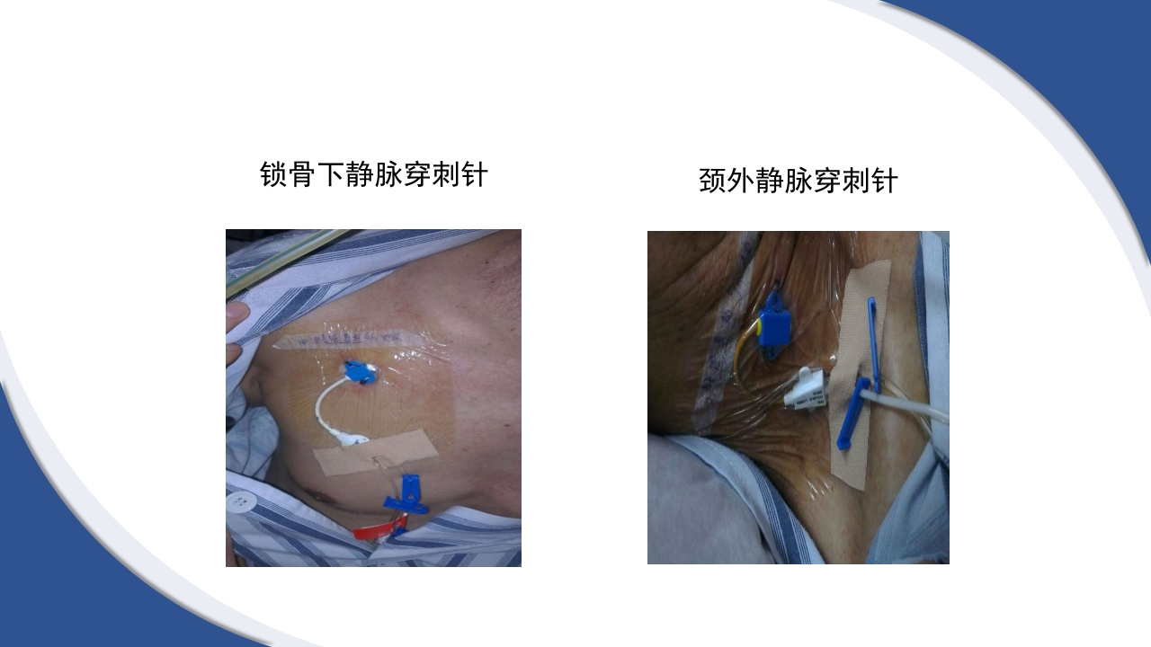 普通外科围手术期护理及术后各类引流管的护理PPT课件54