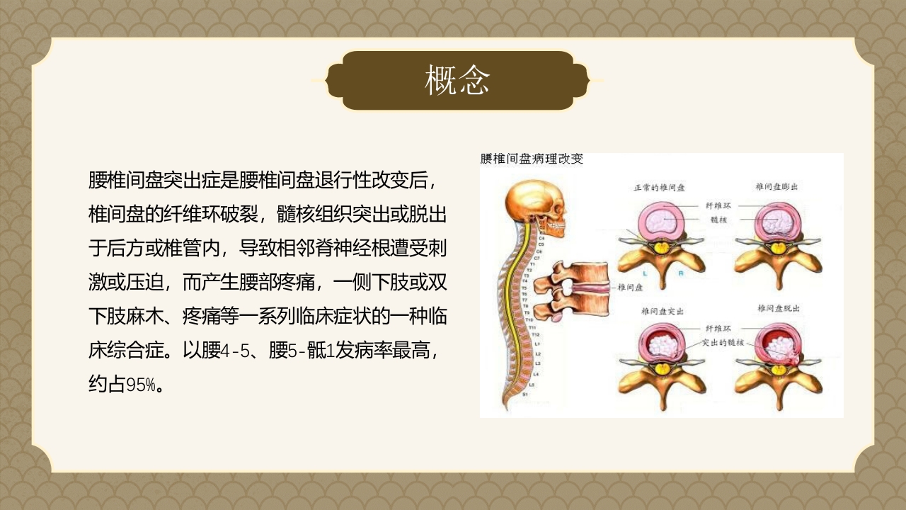 腰椎间盘突出症的中医护理PPT课件4