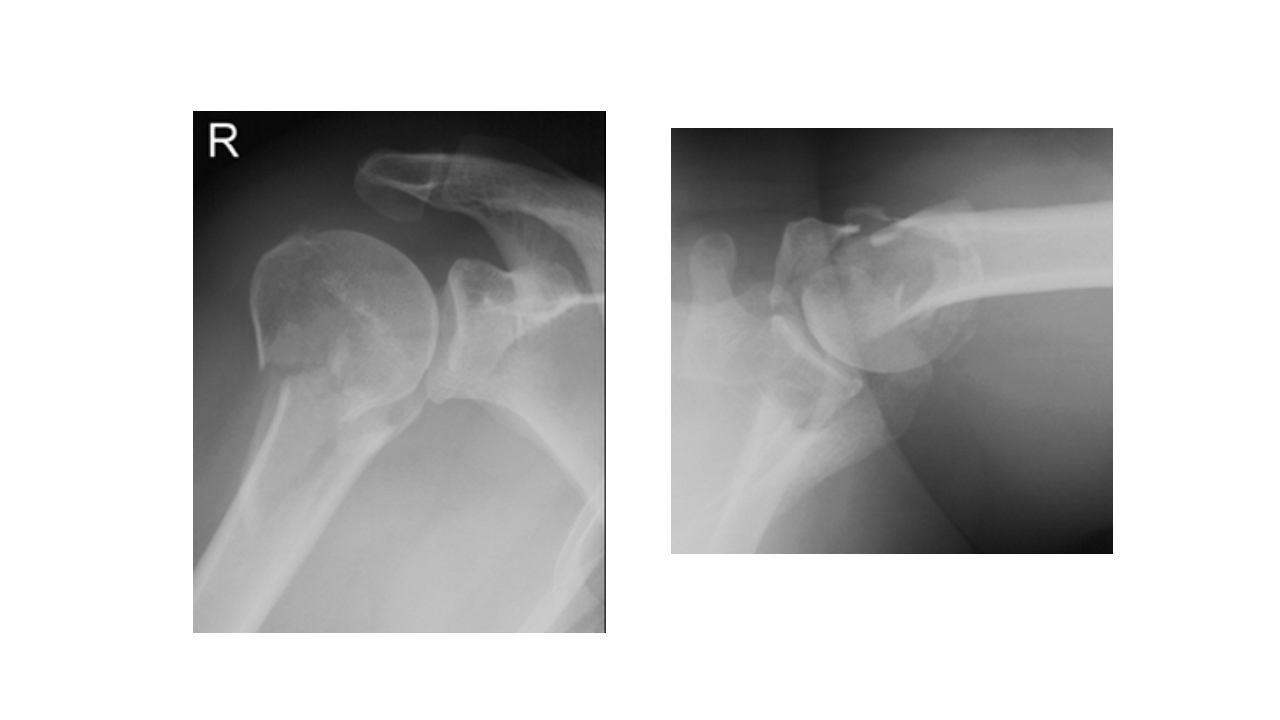 肱骨外科颈骨折PPT课件19