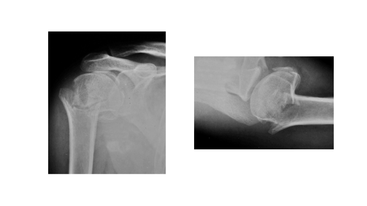 肱骨外科颈骨折PPT课件21