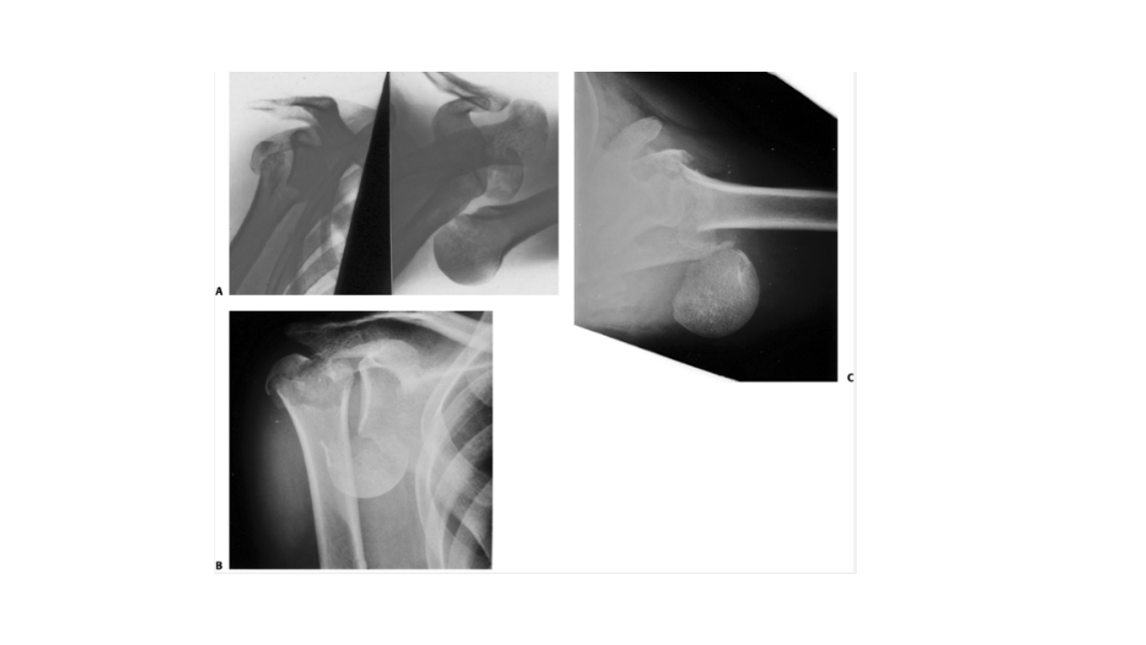 肱骨外科颈骨折PPT课件23
