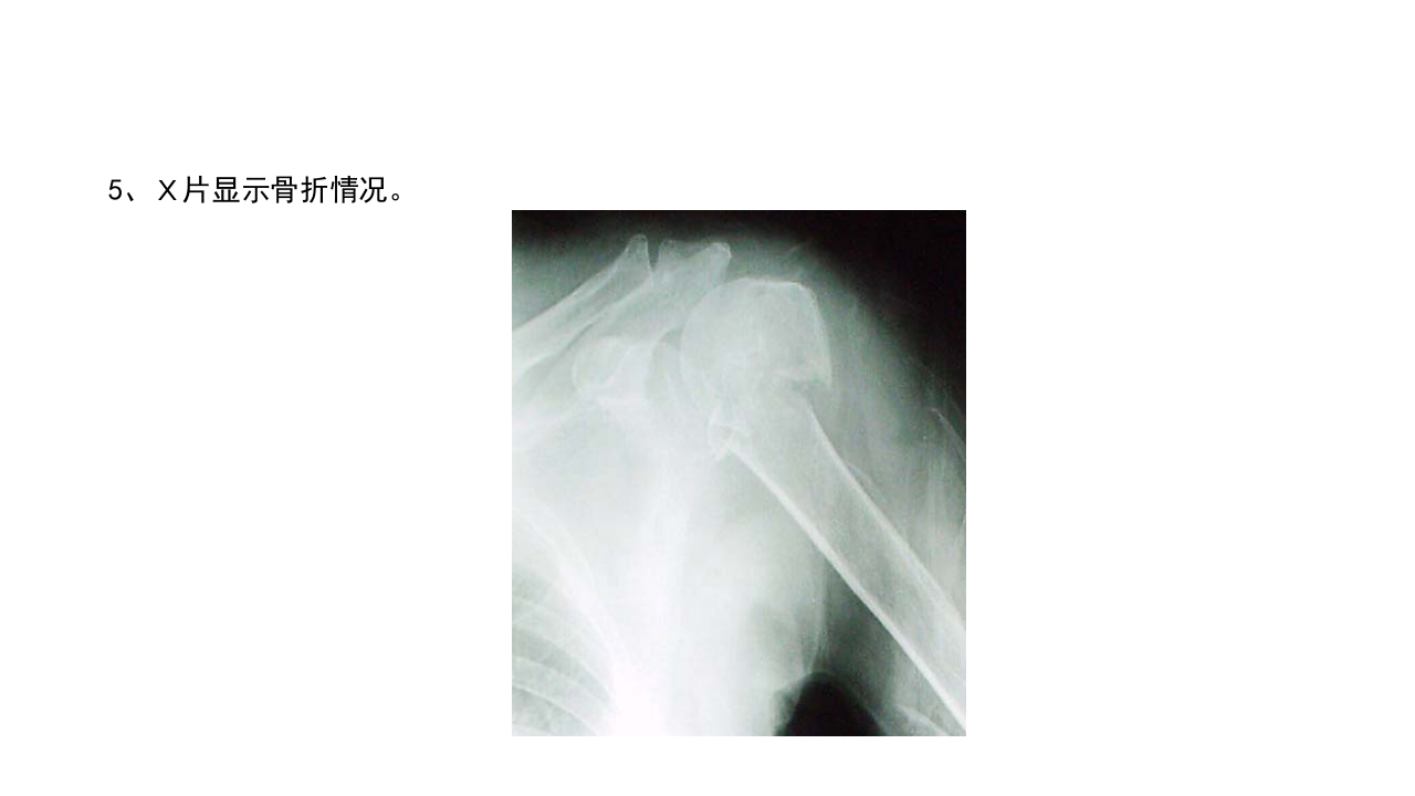 肱骨外科颈骨折PPT课件25