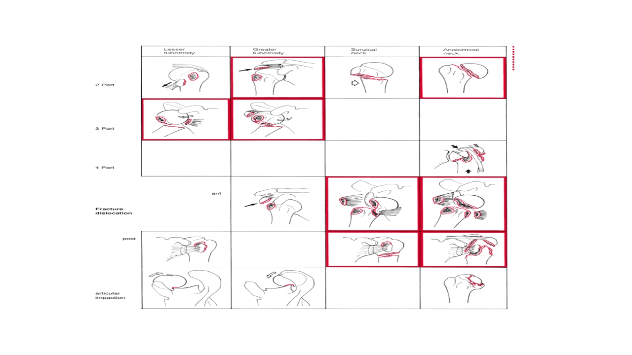 肱骨外科颈骨折PPT课件27