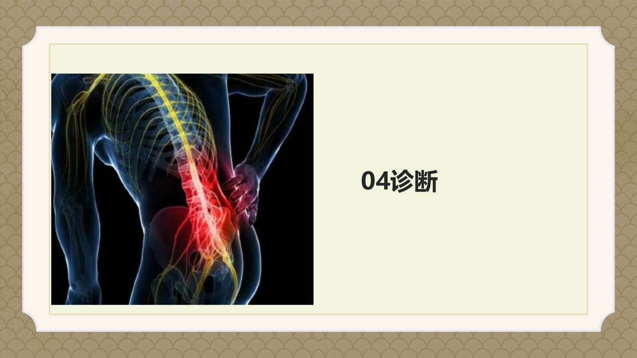 腰椎间盘突出症中医辨证论治ppt课件15