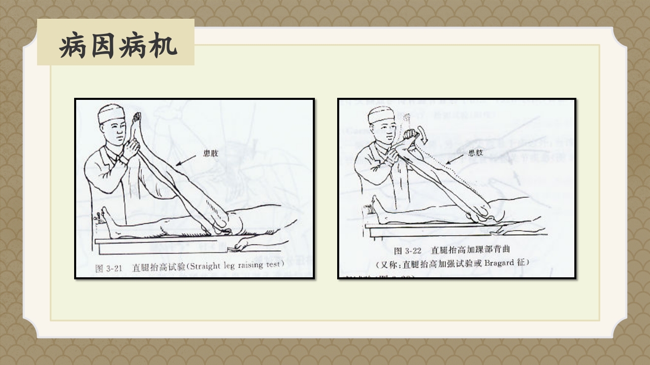 腰椎间盘突出症中医辨证论治ppt课件20