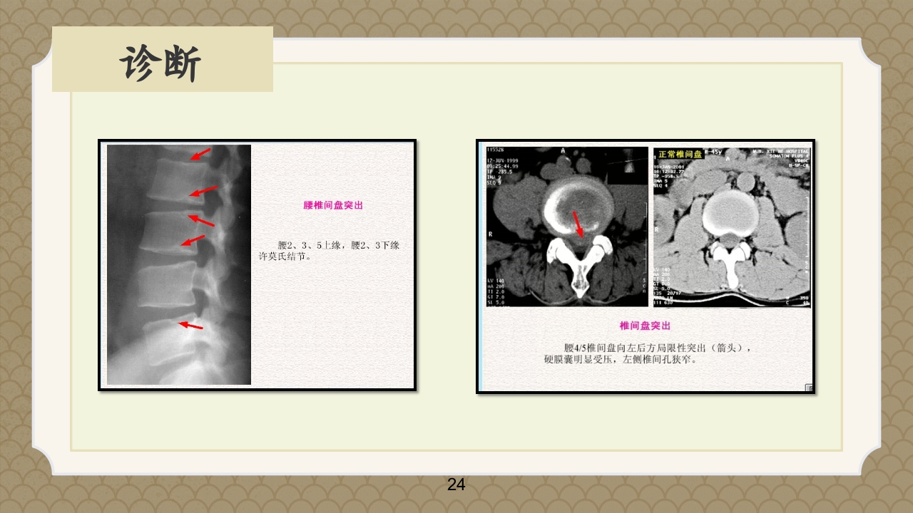 腰椎间盘突出症中医辨证论治ppt课件24