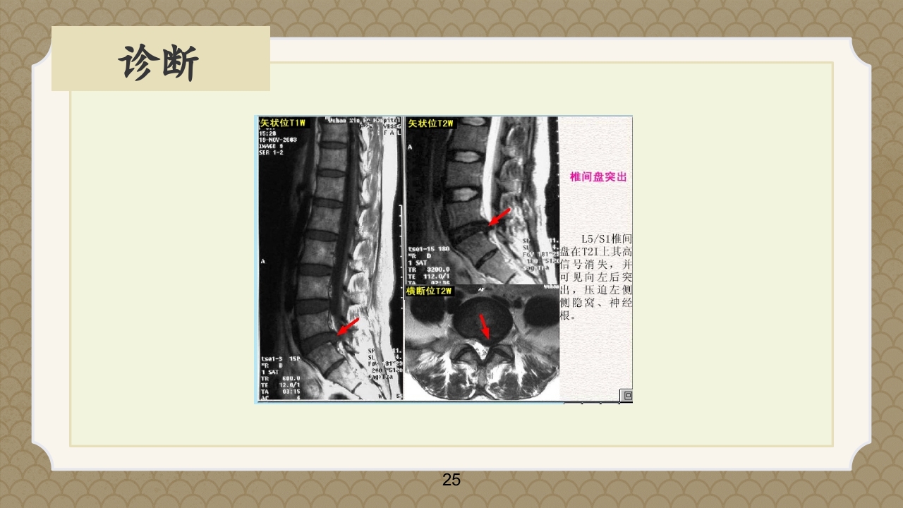 腰椎间盘突出症中医辨证论治ppt课件25