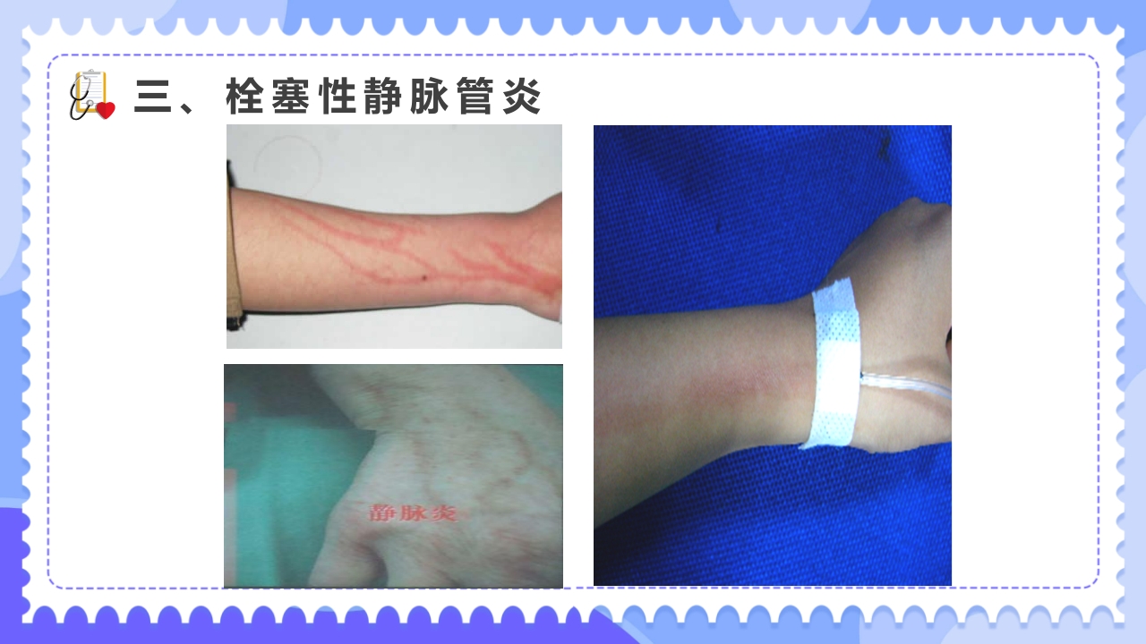 常见化疗药物不良反应及护理PPT课件9