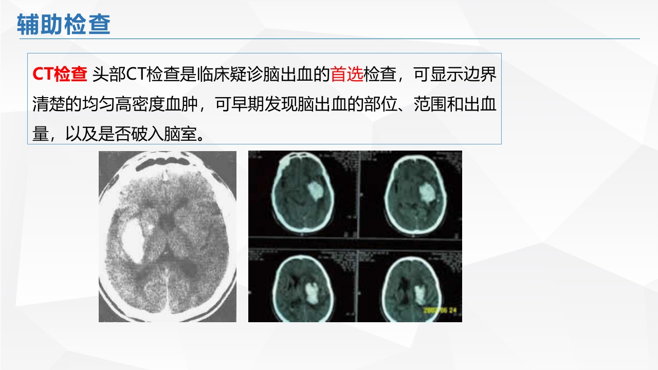 脑出血的护理PPT课件14