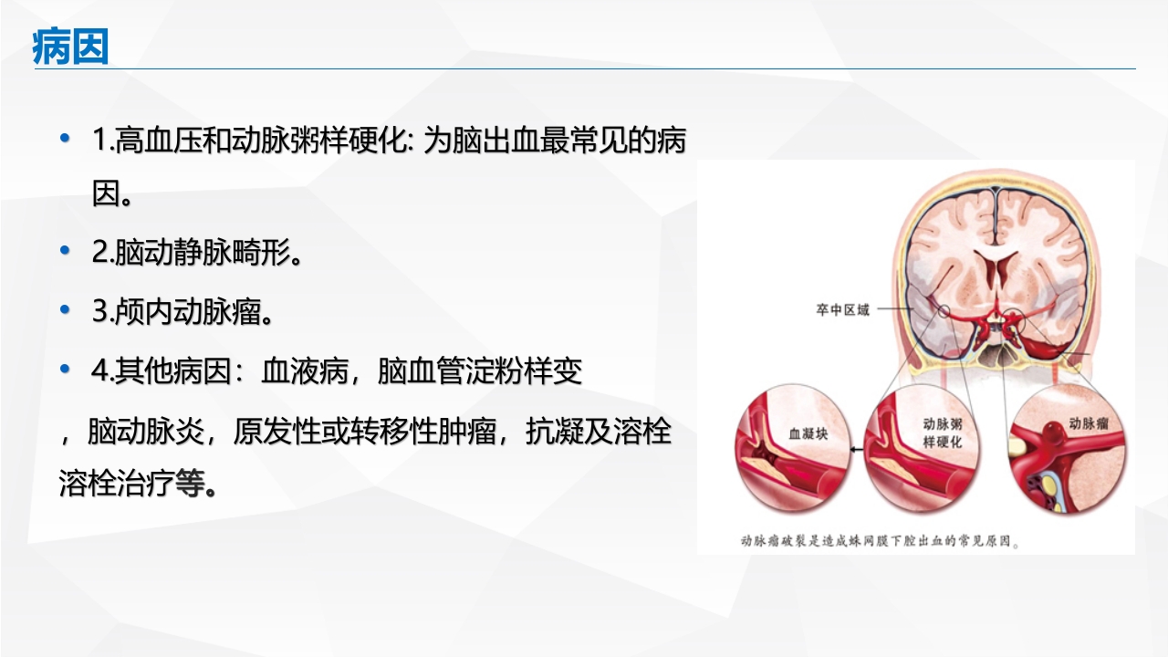 脑出血的护理PPT课件6