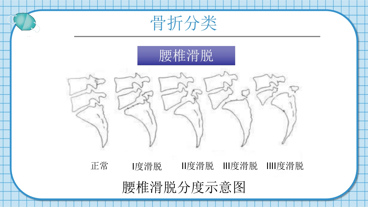 腰2椎体爆裂骨折并不全瘫痪护理查房PPT课件10