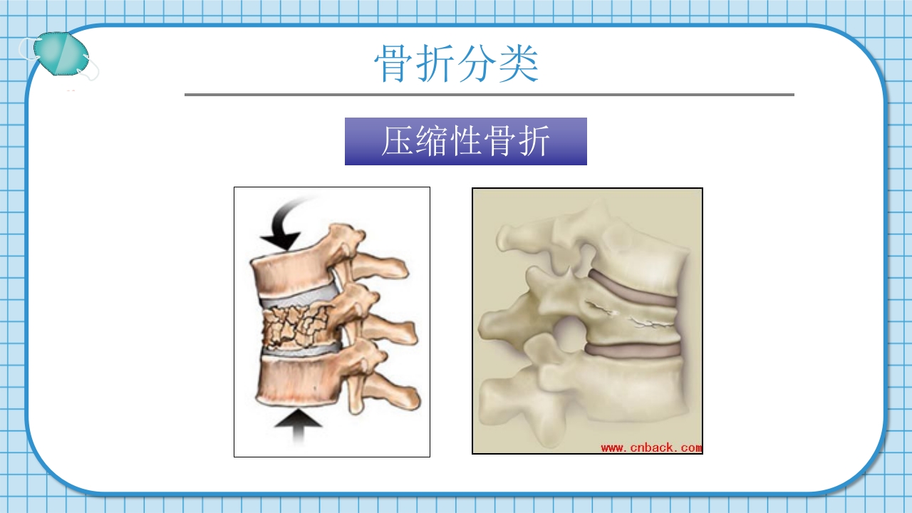 腰2椎体爆裂骨折并不全瘫痪护理查房PPT课件7