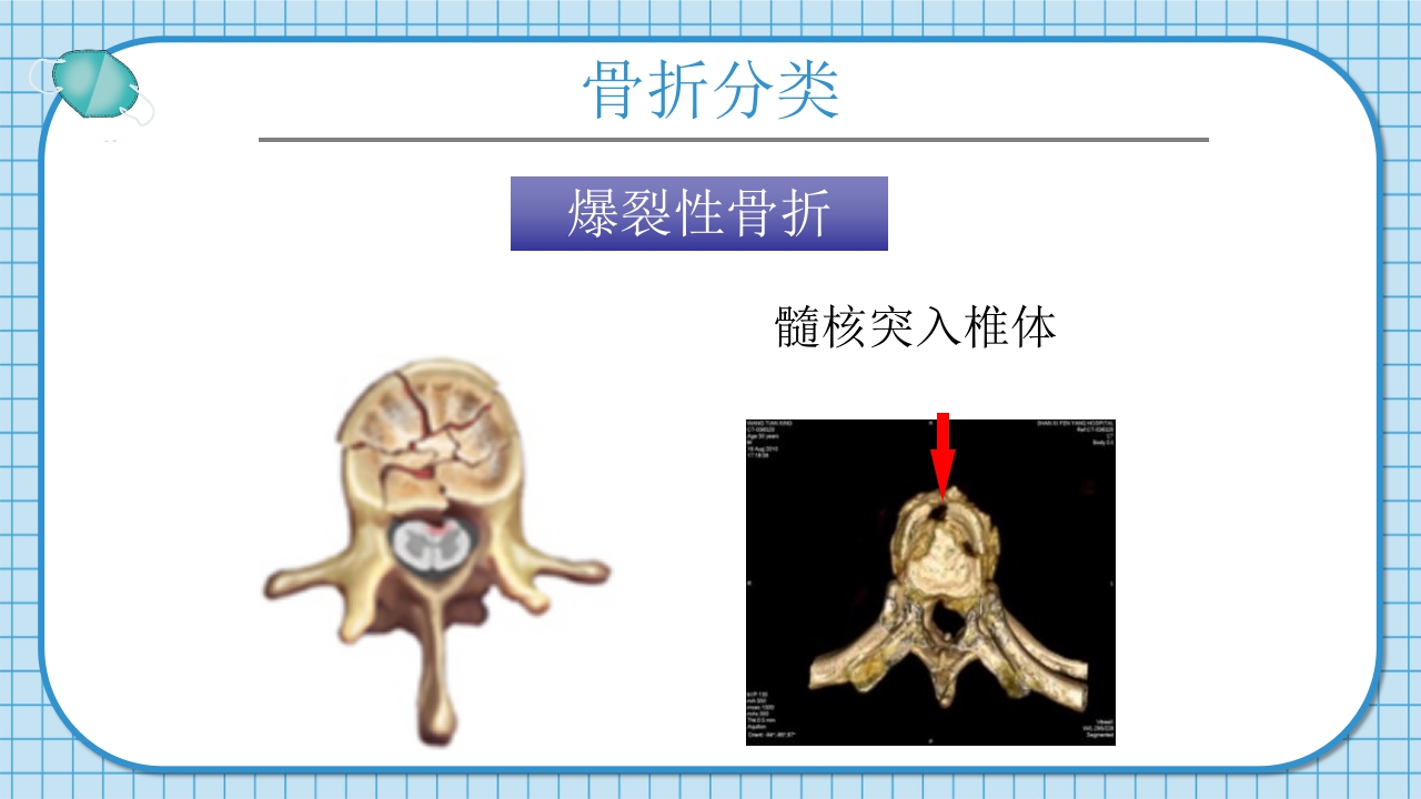 腰2椎体爆裂骨折并不全瘫痪护理查房PPT课件8