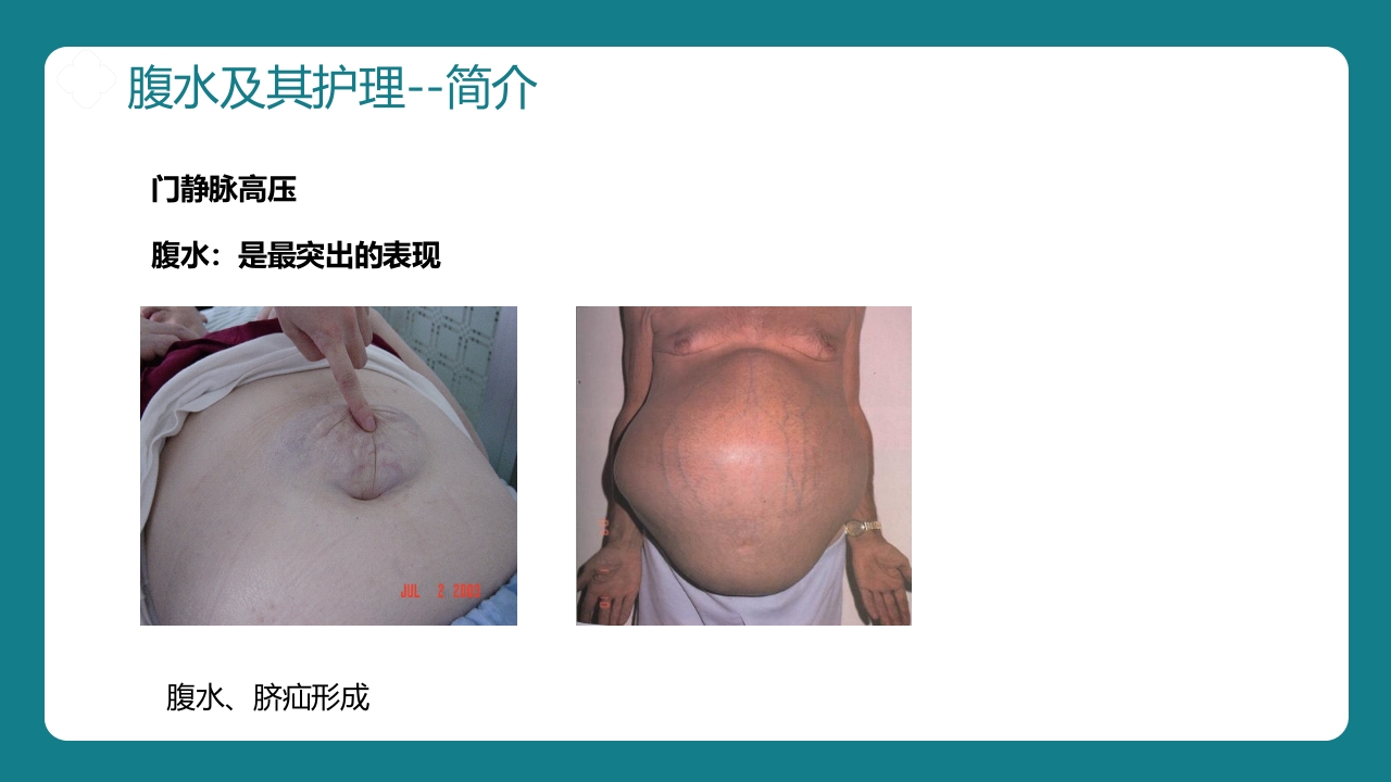 肝硬化腹水病人的护理PPT课件12