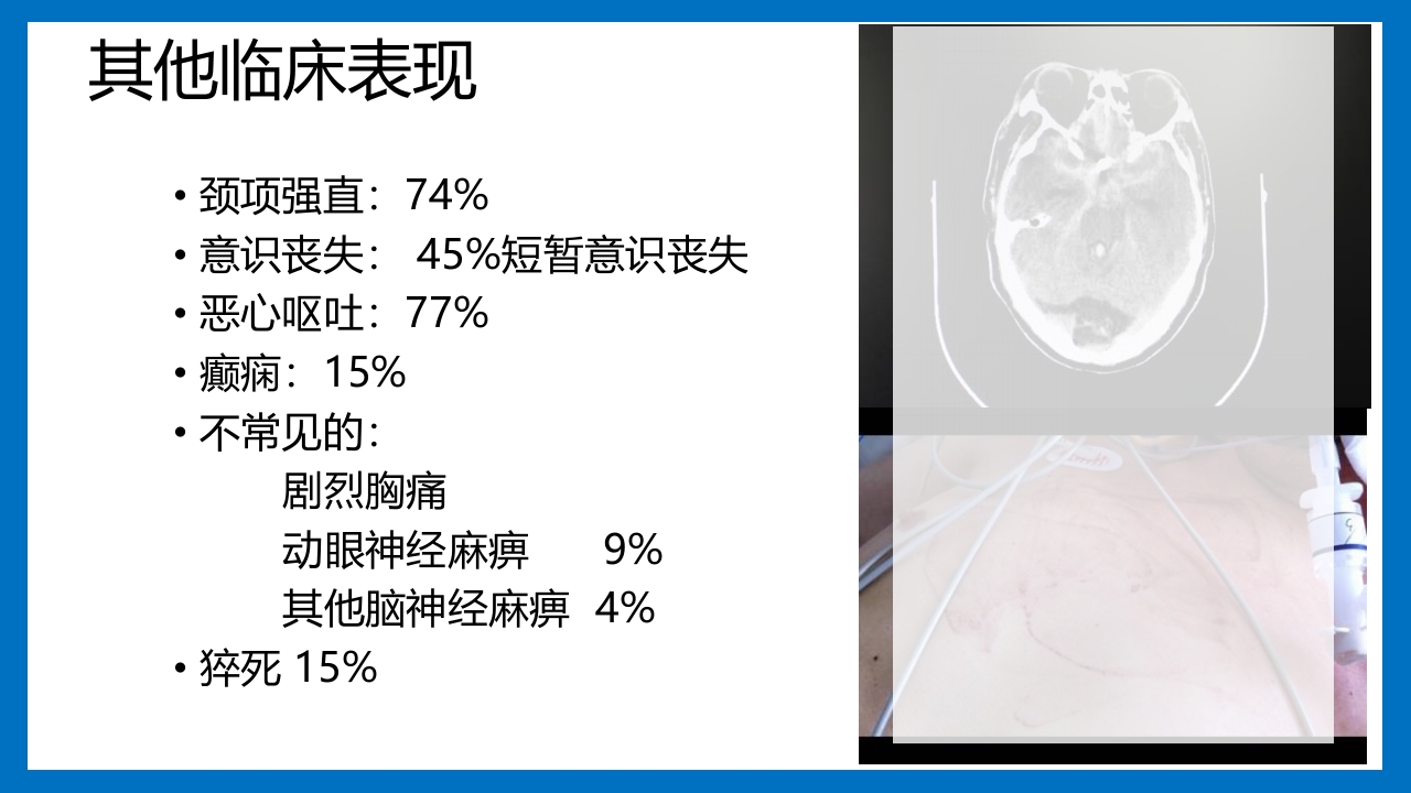 蛛网膜下腔出血的诊断和处理PPT课件11