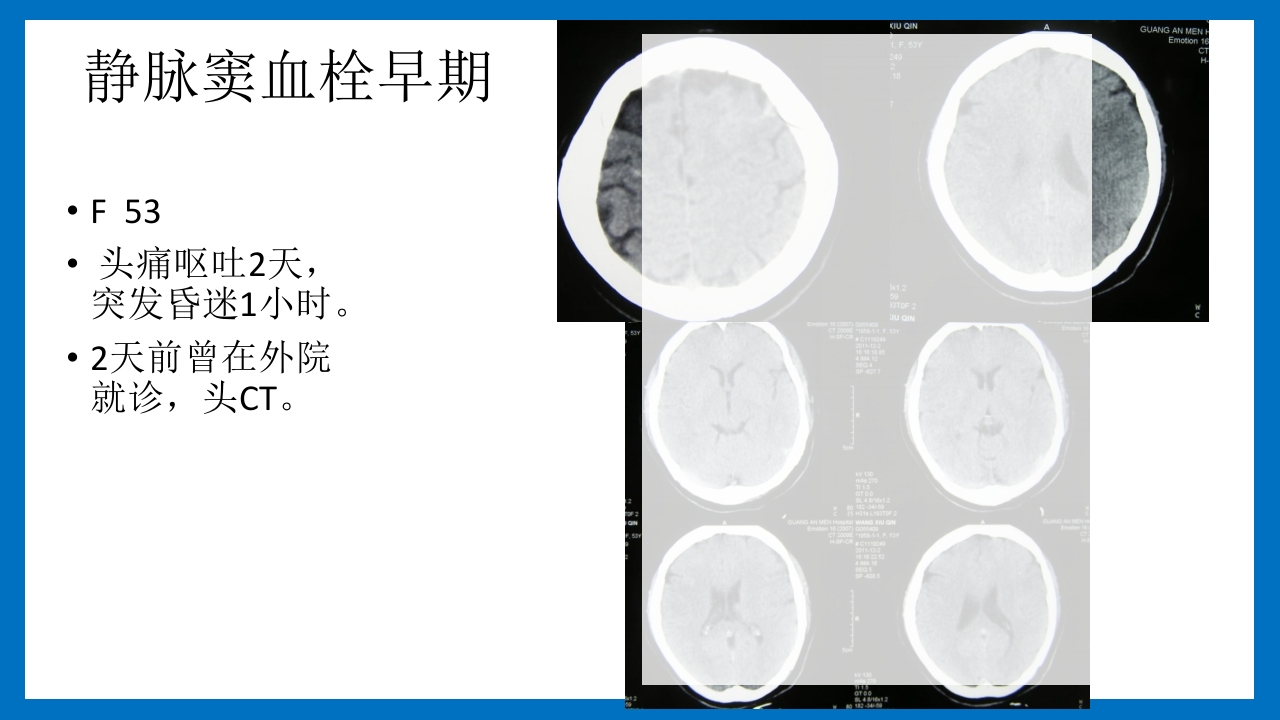 蛛网膜下腔出血的诊断和处理PPT课件16