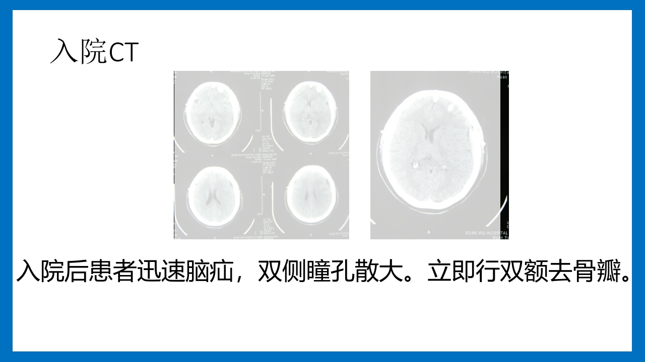 蛛网膜下腔出血的诊断和处理PPT课件17