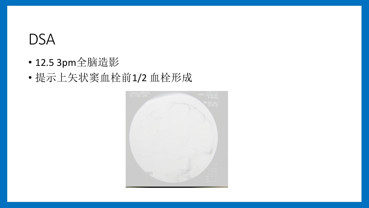 蛛网膜下腔出血的诊断和处理PPT课件18