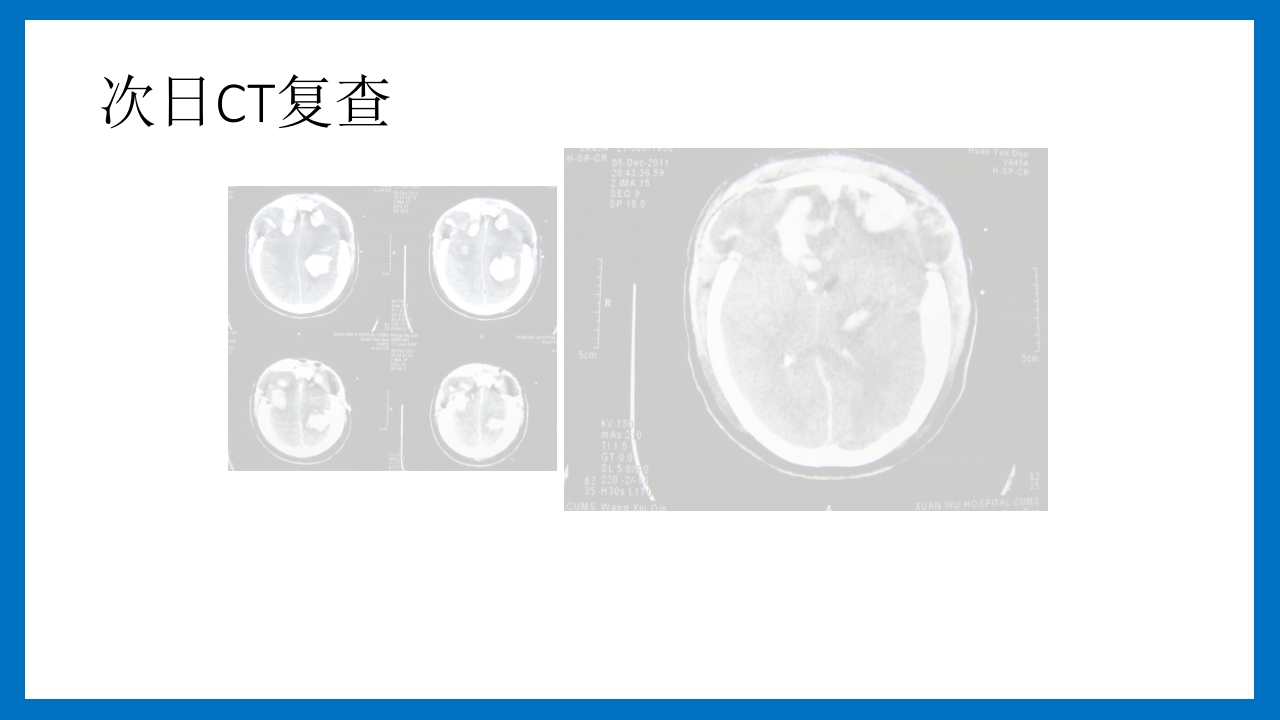 蛛网膜下腔出血的诊断和处理PPT课件19