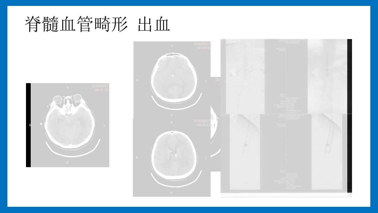 蛛网膜下腔出血的诊断和处理PPT课件21