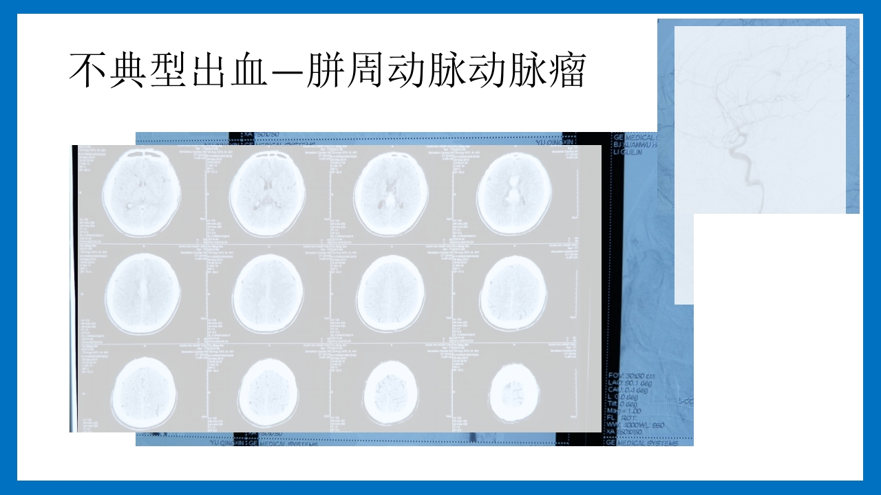 蛛网膜下腔出血的诊断和处理PPT课件22