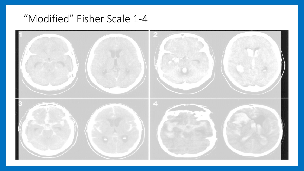 蛛网膜下腔出血的诊断和处理PPT课件27