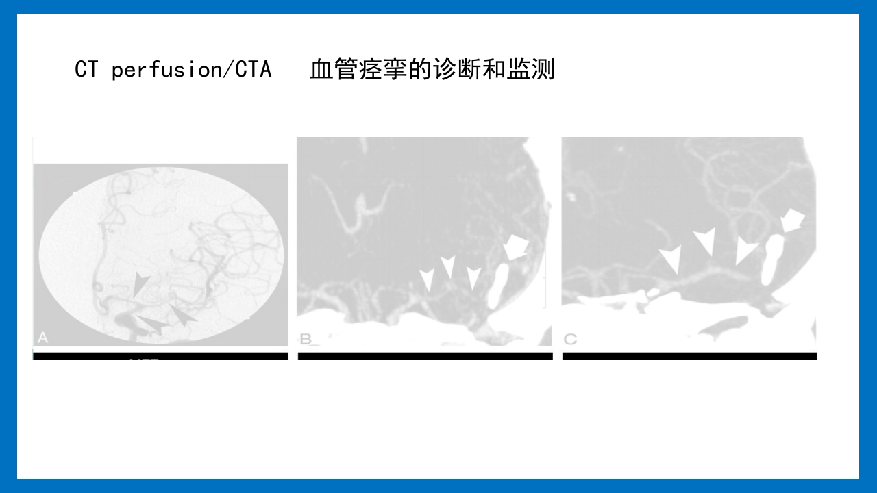 蛛网膜下腔出血的诊断和处理PPT课件31