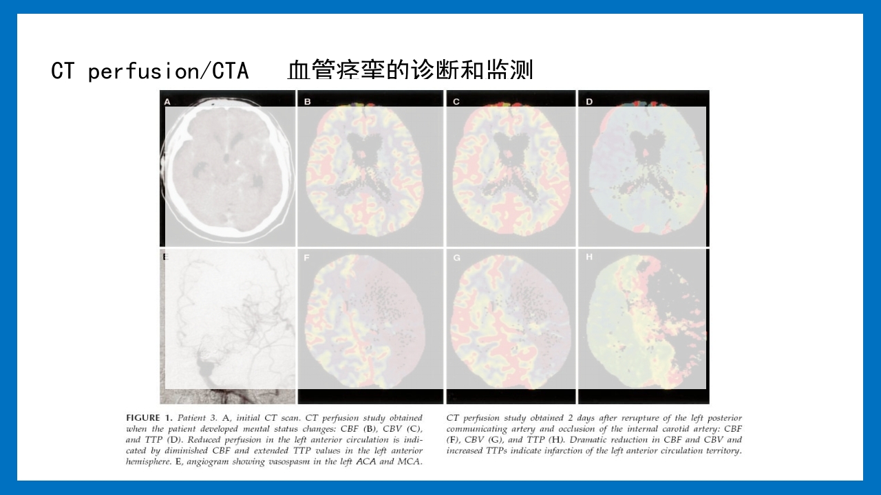 蛛网膜下腔出血的诊断和处理PPT课件32